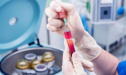 Tips to Find the Best Platelet Rich Plasma Kit