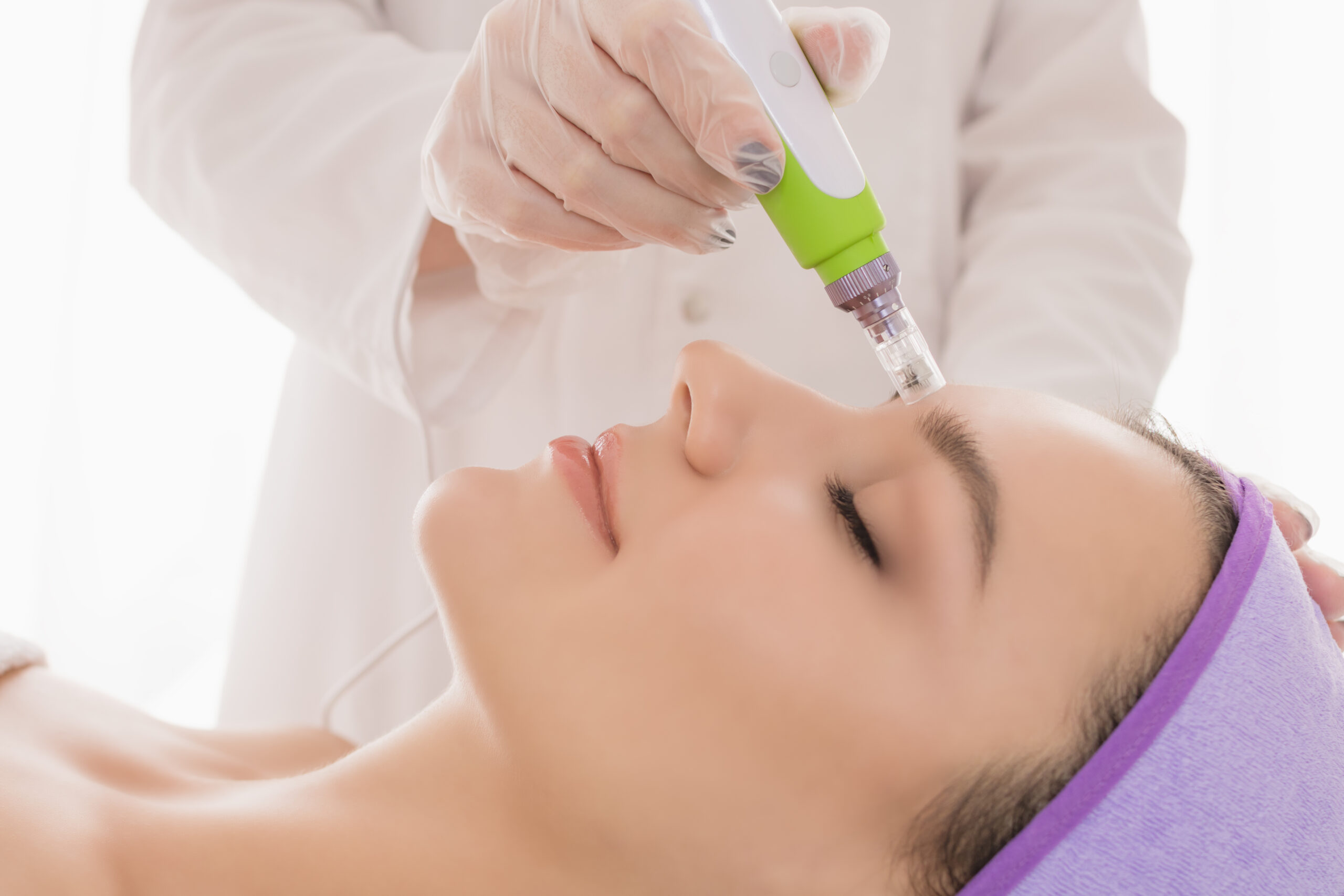 Microneedling Therapy 